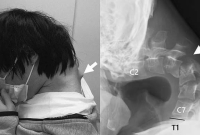 90도로 꺾인 목…범인은 '스마트폰 중독'