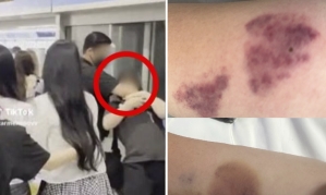 "짐승 다루듯 제압 당해, 전치 4주"…'과잉 경호' 피해자 사진 공개