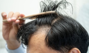 "머리 다 빠집니다" 전문가 경고…추울 때 특히 조심하라는데