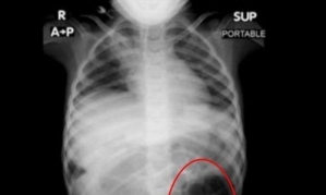 Young Girl Complaining of Abdominal Pain... A Mass of "This" Found in Her Stomach