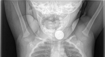 리모컨 가지고 놀다 중환자실 간 4살 아이…식도서 '이것' 나왔다