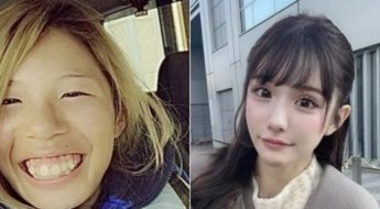 "엄마와 친구들이 못생겼다고 괴롭혀" 2억 모아 25번 성형한 日여성