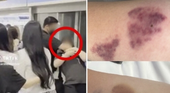 "짐승 다루듯 제압 당해, 전치 4주"…'과잉 경호' 피해자 사진 공개