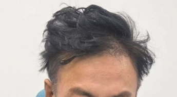 "1000만 탈모인 고민 대통령이 해결해주세요"…박명수 때아닌 호소