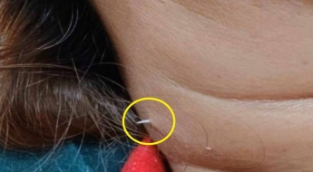 병원 가서도 못 빼낸 생선 가시…2주 만에 목 뚫고 나와