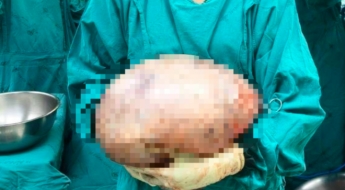 "많이 먹어서 살찐 게 아니었어?"…배에서 나온 8kg짜리의 정체 