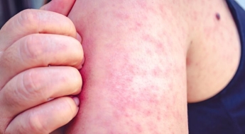 어느새 확진자 2배 돌파 '조용한 유행'…"더 이상 청정 지역 아니다"