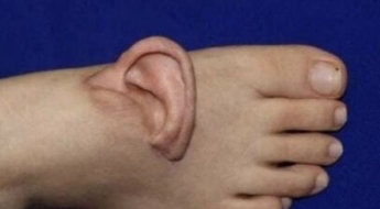 발등에서 귀가 왜 나오는데?…5개월 만에 되돌린 의학의 기적