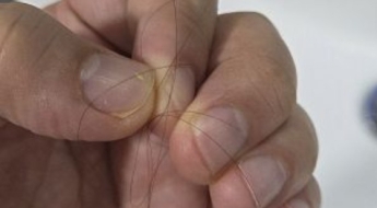 탈모 고민에 빠진날:부작용 이야기