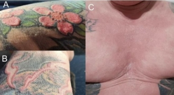 "문신 하나 했을 뿐인데"…전신 탈모에 땀샘 파괴된 30대 남성, 학술지에도 보고