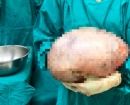 "많이 먹어서 살찐 게 아니었어?"…배에서 나온 8kg짜리의 정체 