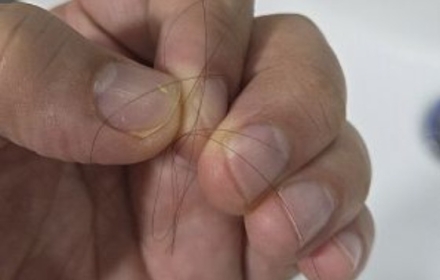 탈모 고민에 빠진날:부작용 이야기