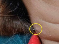 병원 가서도 못 빼낸 생선 가시…2주 만에 목 뚫고 나와
