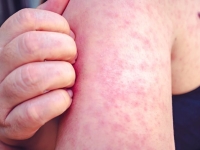 어느새 확진자 2배 돌파 '조용한 유행'…