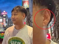 김수용 '귓불 주름' 심근경색 관련있나?…'슬의생' 전문가 분석 들어보니