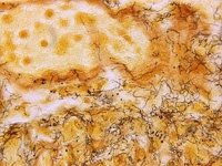 어느새 1만명 훌쩍…다시 고개 드는 '이 질병'에 보건당국 '긴장'