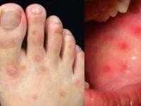 확진 숨기고 학교갔다가 집단감염…