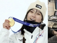'투혼의 금메달'…스노보드 최가온 