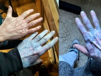 "자고 일어나니 온몸이 '아바타'처럼 변했다"…파랗게 변한 피부에 응급실까지, 무슨 일