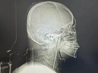 "수술 싫어서"…목에 12㎝ 젓가락 박힌 채 8년 버틴 中 남성