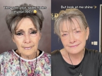 "30년을 되돌렸다"…안면거상술로 변신한 70대 여성 '화제'