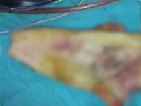 수술 뒤 복통 때문에 찾은 병원서 발견된 '이것'…결국 장 일부 도려냈다