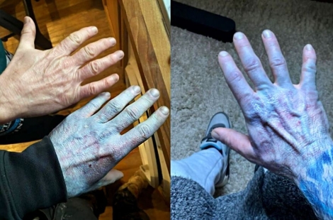 "자고 일어나니 온몸이 '아바타'처럼 변했다"…파랗게 변한 피부에 응급실까지, 무슨 일