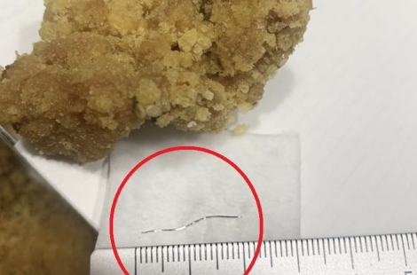 치킨 먹다 구토, 목에 2㎝ 철사 박혔는데…치킨회사 책임 없다고?[최석진의 로앤비즈]