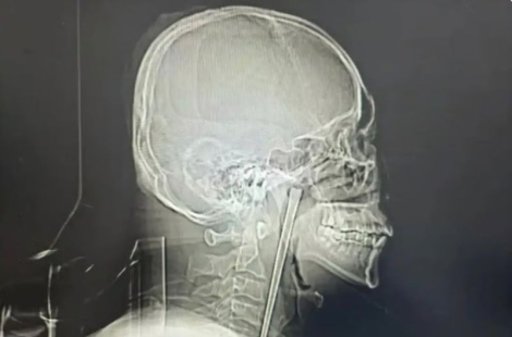 "이게 8년 됐다고요?" 충격받은 의사…12㎝ 젓가락 삼키고 버틴 남성