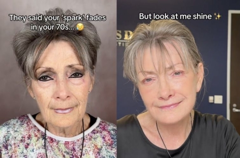 "30년을 되돌렸다"…안면거상술로 변신한 70대 여성 '화제'