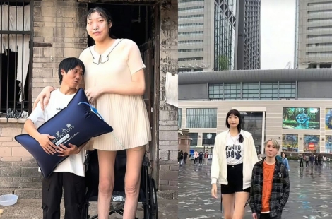 키 220㎝ 26세 여성 출산 후 1년 만에 …'거인증' 뒤 숨겨진 치명적 합병증