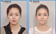 사각턱 양악수술, 3차원 CT로 입체감살려 갸름하게