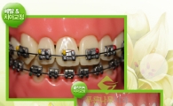 고통은 줄고 치료기간 짧은 '클리피씨 치아교정'
