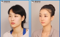 양악수술의 핵심은 자연스러운 턱라인 만들기