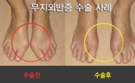 ‘킬힐’로 변형된 엄지발가락 방치땐 관절·허리까지 ‘골병’