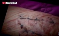 요양원 치매노인 폭행, '은폐' 의혹에 뒤늦게 '해고'