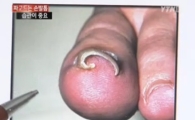 내향성 발톱 치료법 알아보니…"'이것'만 있으면 해결!"