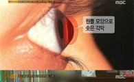 'PD수첩' 라식·라섹 부작용 "원추각막증때문에 자살 생각까지"