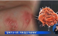 가을철 '옴' 주의보, 전염성 매우 높아… "효과적인 예방법은?"