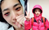 '얼짱 파이터' 박지혜 승리 후 모습 공개, 눈 주변 피멍 자국… 팬들 "너무 안타까워"