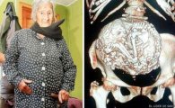 92세 할머니 뱃속서 50년 전 죽은 태아 발견 '충격'