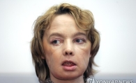 세계 최초 안면이식 수술받은 여성, 11년만에 사망…거부반응 재발?