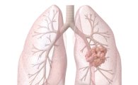 [건강을 읽다]'날숨'만으로 폐암 검사하는 시대 온다