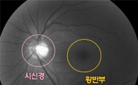 녹내장 조기 진단 가능해졌다