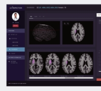 AI Precisely Predicts Optimal Timing for Atrial Fibrillation-Related Stroke Treatment... 87% Agreement with Specialists