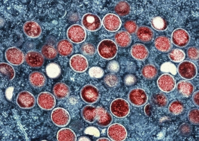 "치명률 높고 전파 속도 빨라"…이 질병 변종 또 나와 "두통 등 증상 나타나면 조심해야"