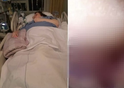 독감인줄 알았는데 희귀질환…엉덩이 괴사에 대수술 받은 여성