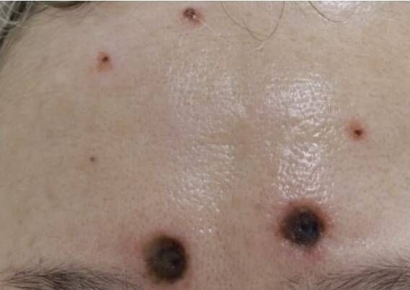 점 빼려고 발랐는데 피부 괴사…'알리 직구' 크림에 난리난 일본