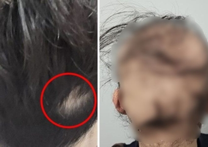 "석달새 다 빠지고 여친도 떠나" 급성탈모 공개한 남성, 원인은 이것