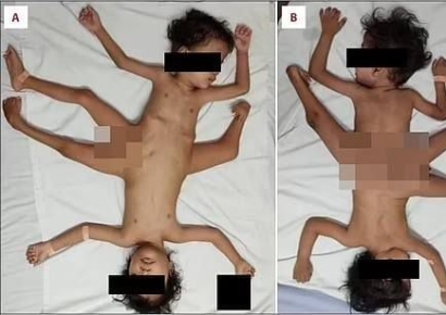 골반 붙은 채 태어난 샴쌍둥이…"3년 만에 앉고 조금씩 설 수도"